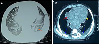 Staphylococcus aureus bacteremia complicated with non-traumatic mediastinal abscess in children: A case report